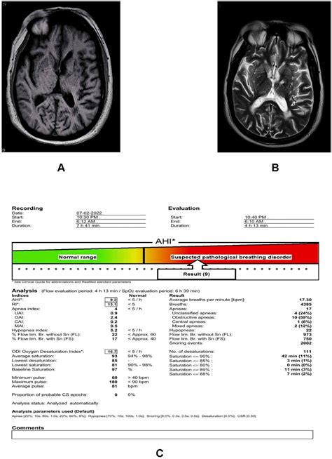 seizures of unknown origin.